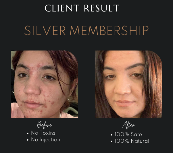 Non-Surgical Face Lift Newcastle