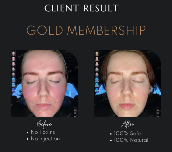 Non-Surgical Face Lift Newcastle