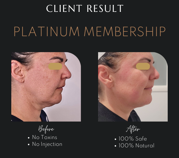 HIFU Non Surgical Facelift