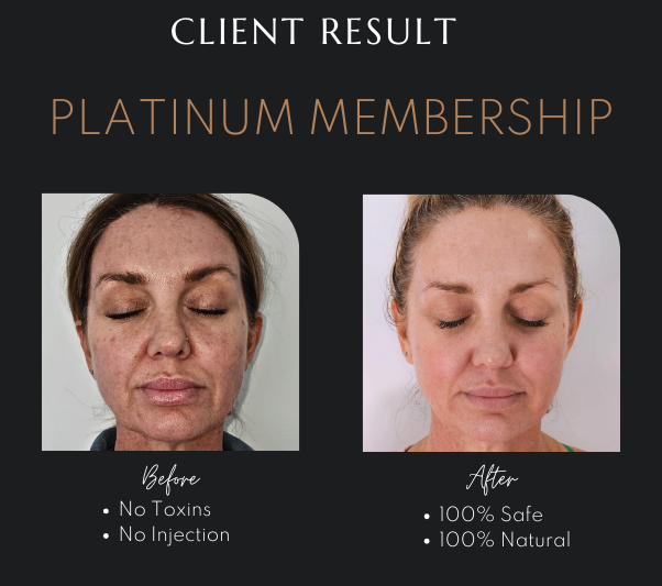 Plasma Infusion Facial Newcastle