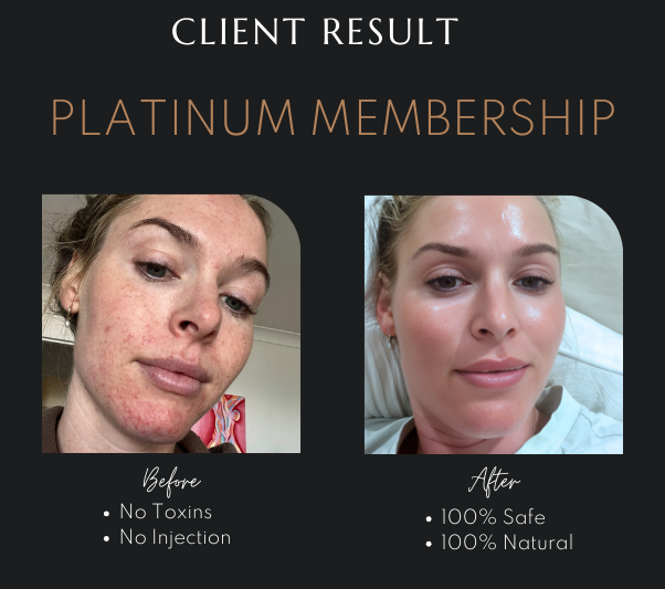 RF Skin Tightening in Newcastle