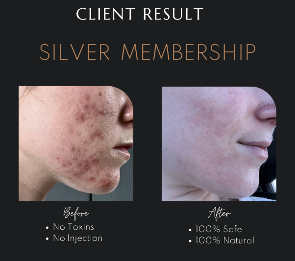RF Skin Tightening in Newcastle