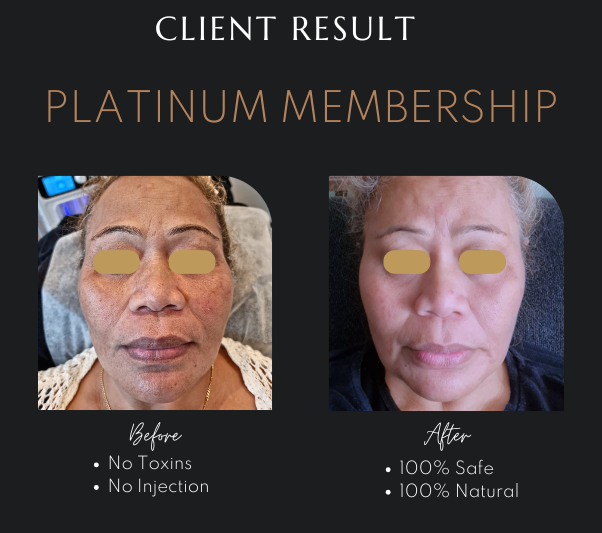 Ultrasound Facelift Newcastle