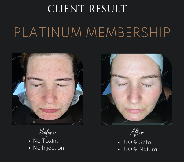 CO2 Laser Skin Resurfacing Newcastle