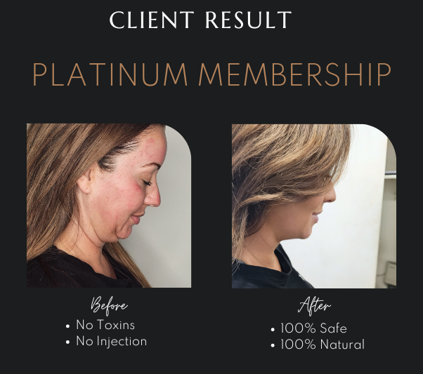 Restore Youthful Skin Without Fillers