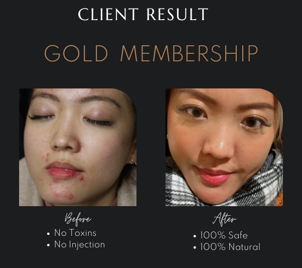 Restore Youthful Skin Without Fillers